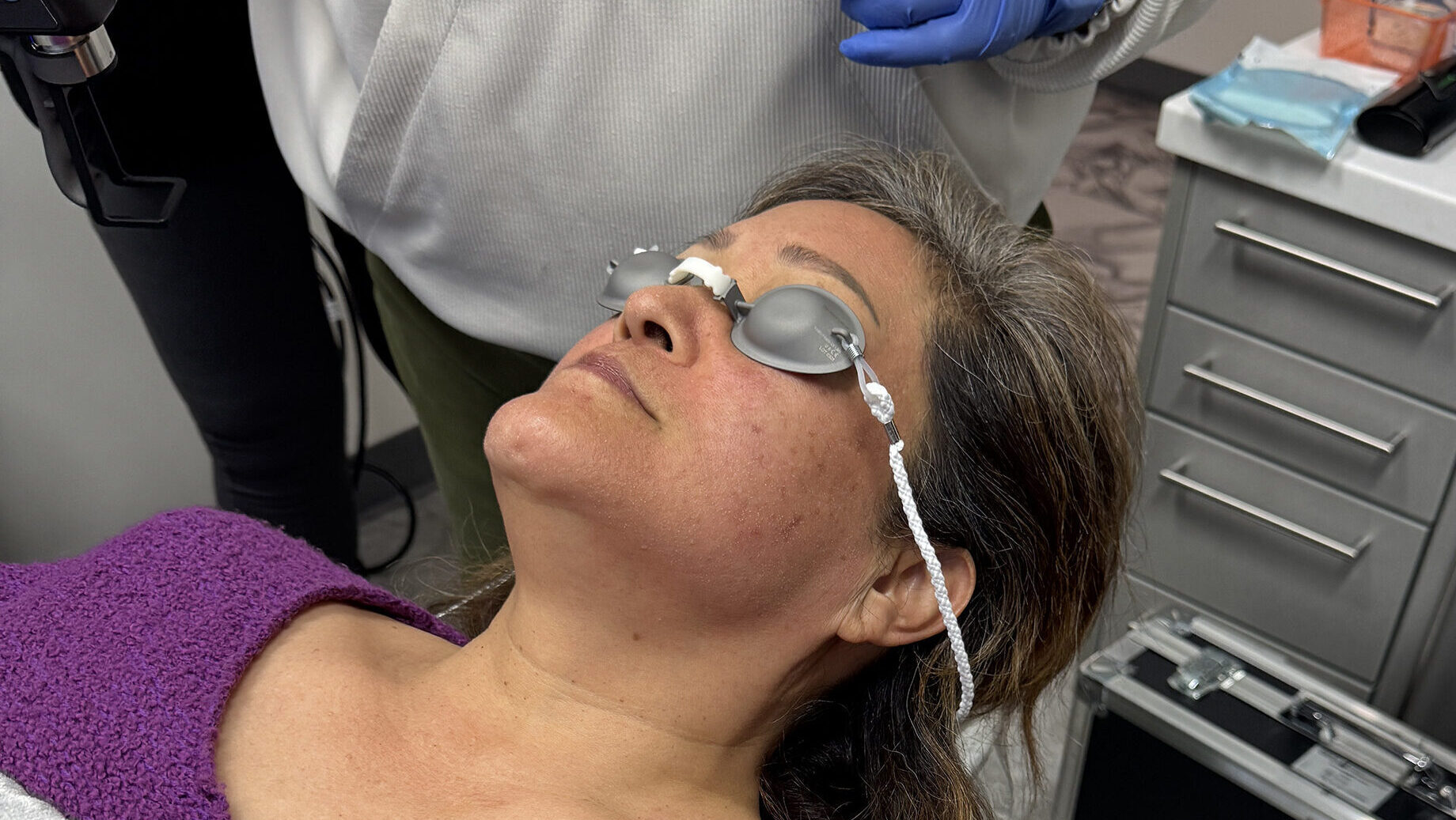 CoolPeel laser facial treatment being performed to reduce wrinkles and improve skin texture