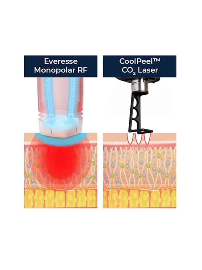 Aesthetic treatment setup featuring the Everesse RF Skin Tightening device and the CoolPeel CO₂ Laser system, showcasing advanced technology for skin rejuvenation, tightening, and resurfacing in a modern clinic environment.